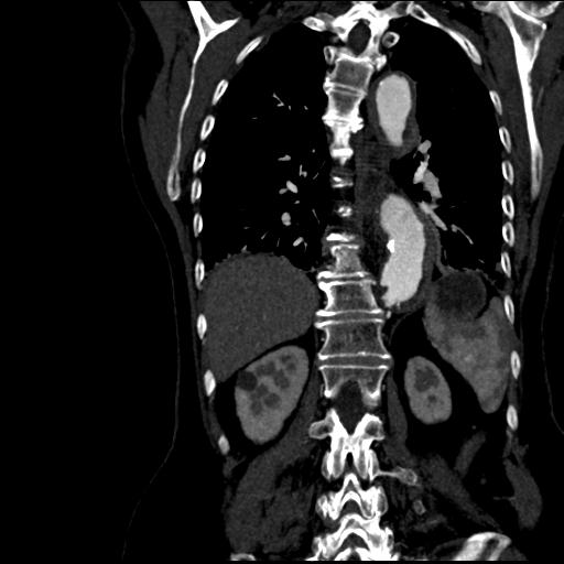 Aortic intramural hematoma from penetrating atherosclerotic ulcer (Radiopaedia 31137-31836 C 47).jpg