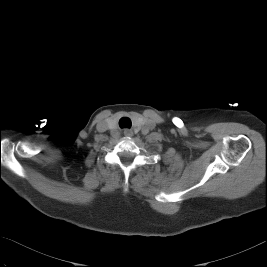 File:Aortic intramural hematoma with dissection and intramural blood pool (Radiopaedia 77373-89491 Axial non-contrast 8).jpg