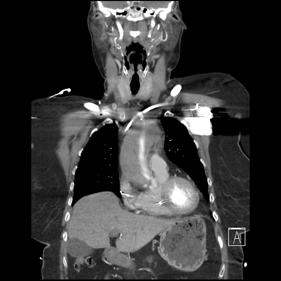 Aortic intramural hematoma with dissection and intramural blood pool (Radiopaedia 77373-89491 C 17).jpg