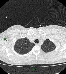 File:Aortic valve endocarditis (Radiopaedia 87209-103485 Axial lung window 20).jpg