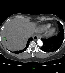 Aortic valve endocarditis (Radiopaedia 87209-103485 C 80).jpg