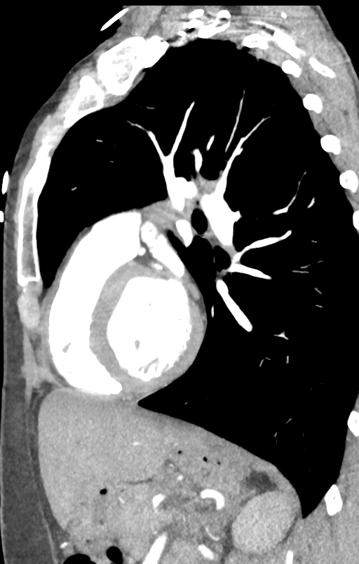 Aortic valve non-coronary cusp thrombus (Radiopaedia 55661-62189 C+ arterial phase 19).png