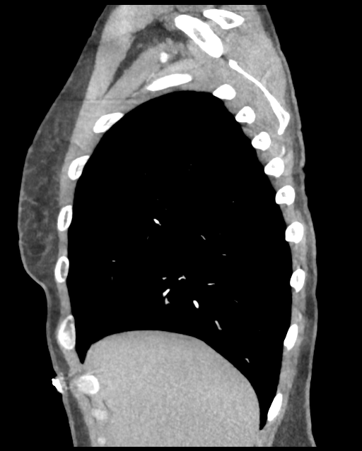 Aortic valve non-coronary cusp thrombus (Radiopaedia 55661-62189 D 44).png