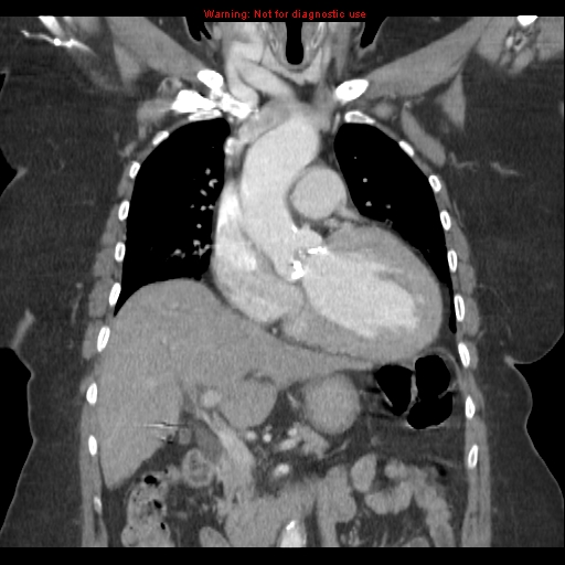 File:Aortic valve stenosis (Radiopaedia 14480-14423 A 8).jpg