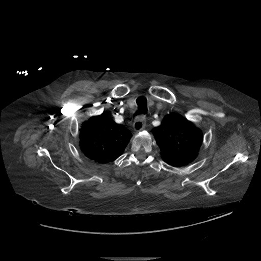 Aortoesophageal fistula with endovascular repair (Radiopaedia 73781-84592 Axial C+ CTPA 6).jpg