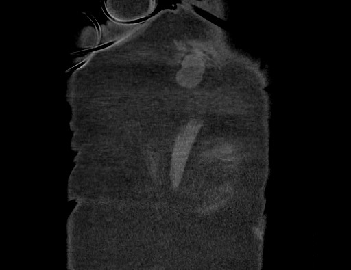 Aortoesophageal fistula with endovascular repair (Radiopaedia 73781-84592 Coronal C+ CTPA 142).jpg