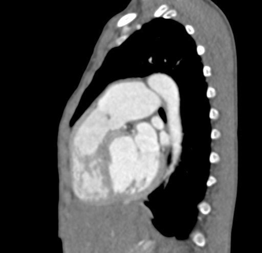 File:Aortopulmonary window, interrupted aortic arch and large PDA giving the descending aorta (Radiopaedia 35573-37074 C 28).jpg