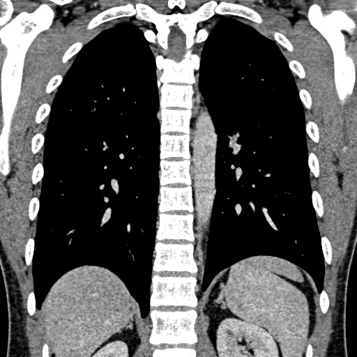 Apical lung mass mimic - neurogenic tumor (Radiopaedia 59918-67521 B 77).jpg