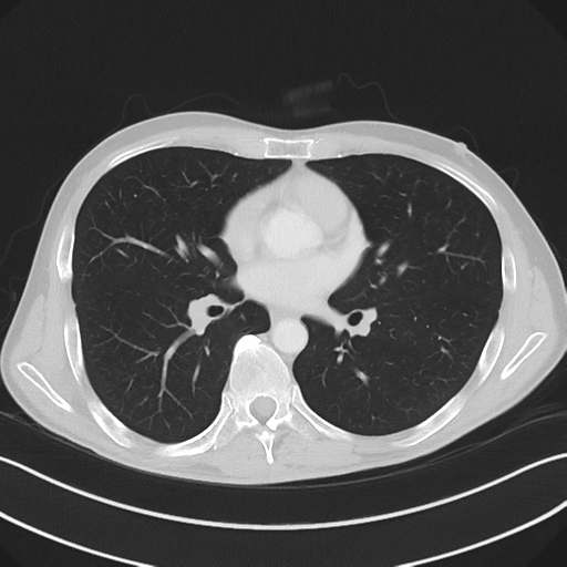 Apical pleural calcification (Radiopaedia 46141-50499 Axial lung window 37).png