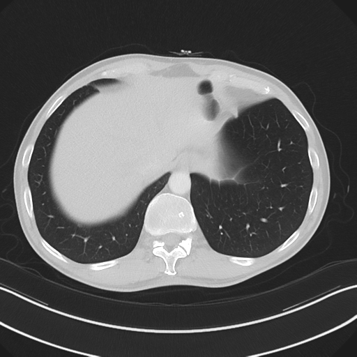 Apical pleural calcification (Radiopaedia 46141-50499 Axial lung window 60).png