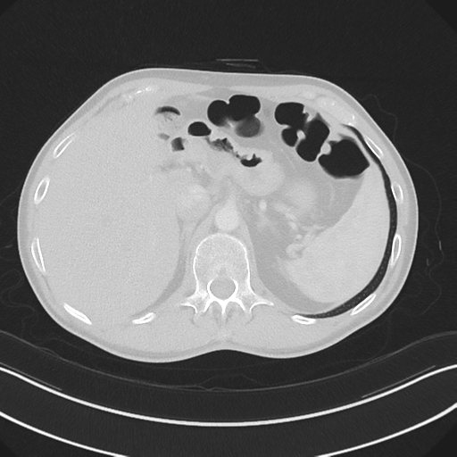 Apical pleural calcification (Radiopaedia 46141-50499 Axial lung window 70).png