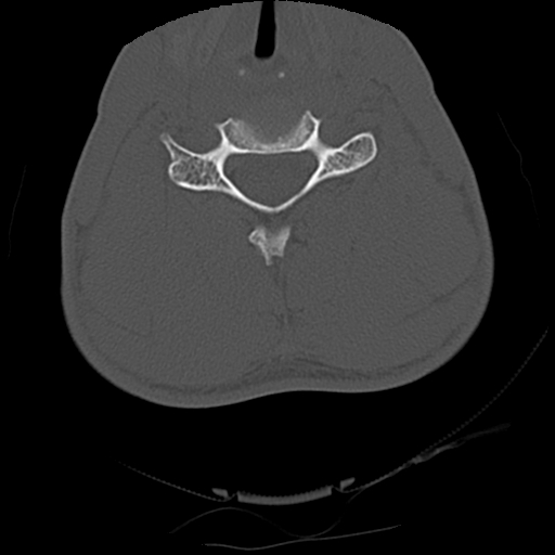 Apical pneumothorax on cervical spine CT (Radiopaedia 45343-49368 Axial bone window 57).jpg