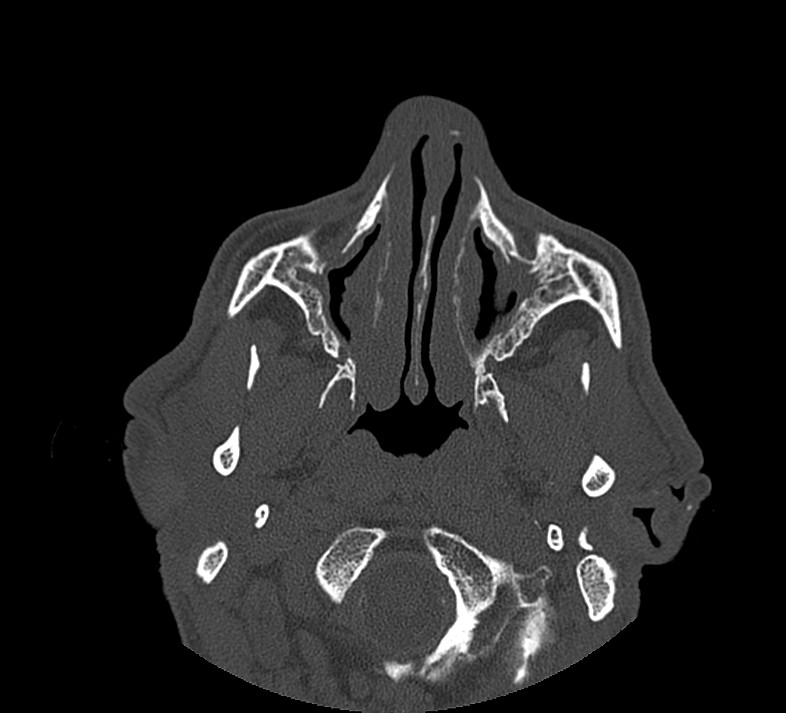 Aplastic maxillary sinuses (Radiopaedia 60030-67561 Axial non-contrast 24).jpg