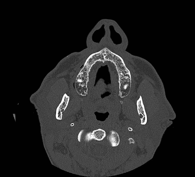 Aplastic maxillary sinuses (Radiopaedia 60030-67561 Axial non-contrast 3).jpg