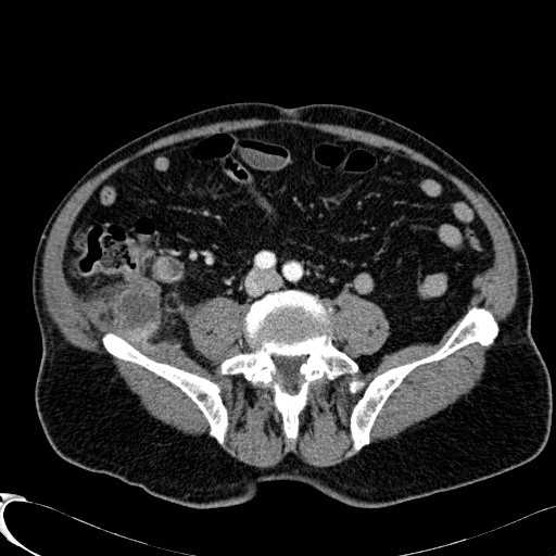 Appendiceal adenocarcinoma complicated by retroperitoneal abscess (Radiopaedia 58007-65039 B 89).jpg