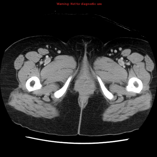 Appendiceal mucinous cystadenoma (Radiopaedia 8263-9111 Axial liver window 88).jpg