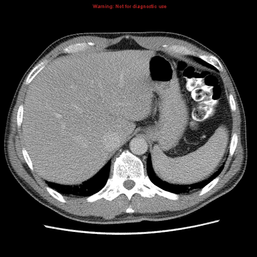 File:Appendicitis and renal cell carcinoma (Radiopaedia 17063-16760 A 9).jpg