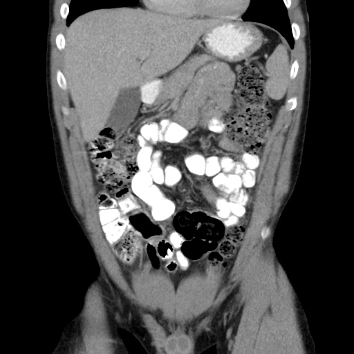 File:Appendicitis complicated by post-operative collection (Radiopaedia 35595-37113 B 19).jpg