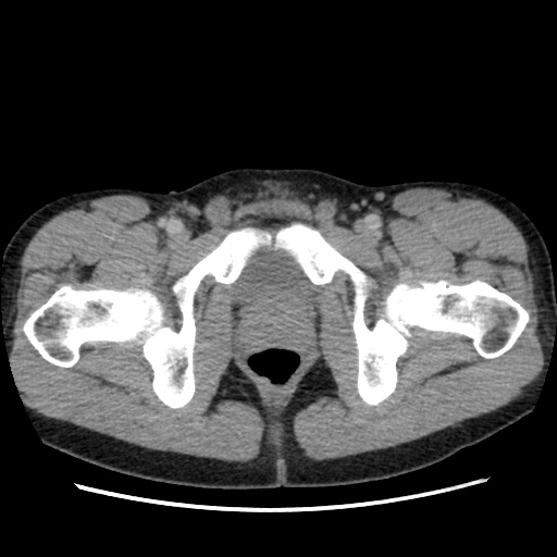 File:Appendicitis complicated by post-operative collection (Radiopaedia 35595-37114 A 87).jpg