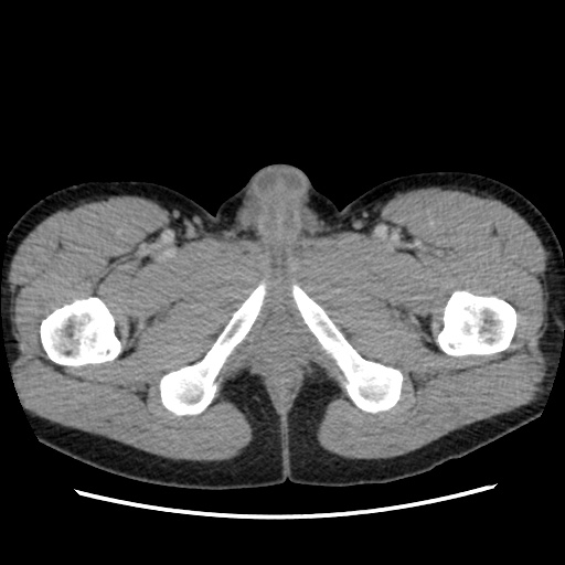 File:Appendicitis complicated by post-operative collection (Radiopaedia 35595-37114 A 94).jpg