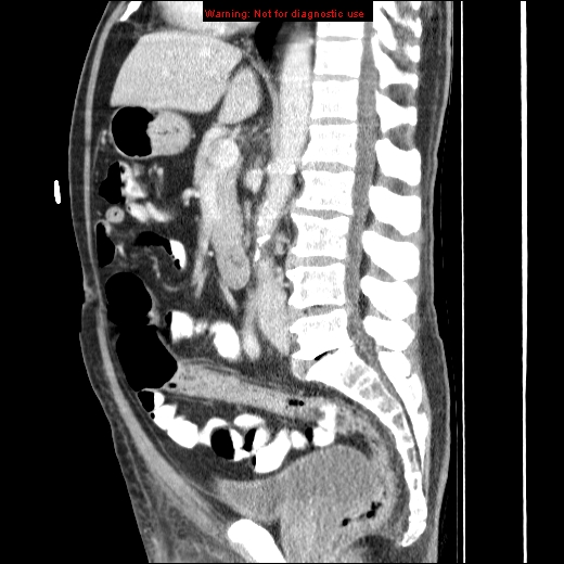 File:Appendicitis mass in inguinal hernia (Radiopaedia 26858-27029 C 27).jpg
