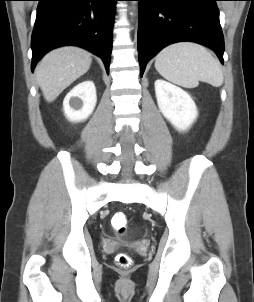 Appendicitis with cecal bar sign (Radiopaedia 31878-32830 A 43).jpg