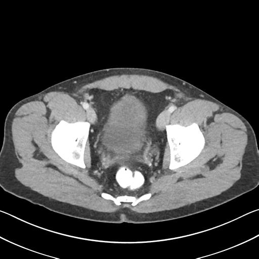 Appendicitis with cecal bar sign (Radiopaedia 31878-32830 B 73).jpg