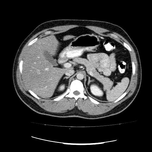 File:Appendicitis with diverticulosis (Radiopaedia 47693-52383 Axial C+ 37).jpg