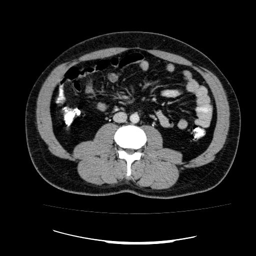 File:Appendicitis with diverticulosis (Radiopaedia 47693-52383 Axial C+ 72).jpg
