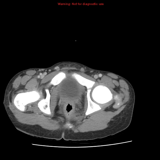 File:Appendicitis with phlegmon (Radiopaedia 9358-10046 A 69).jpg