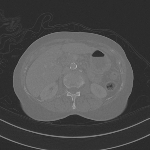 April fools' 2019- calcified peritoneal arachnoidosis (Radiopaedia 67273-76636 Axial bone window 12).png