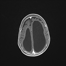 Aqueductal stenosis (Radiopaedia 73974-84802 Axial T1 C+ 115).jpg