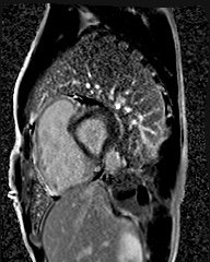 File:Arrhythmogenic right ventricular cardiomyopathy (Radiopaedia 57972-64966 D 4).jpg