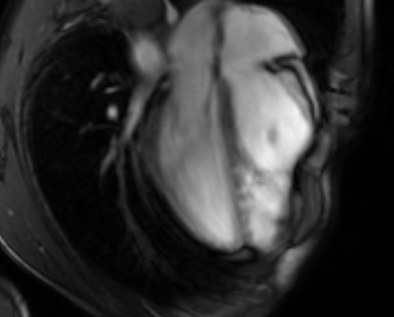 Arrhythmogenic right ventricular cardiomyopathy (Radiopaedia 69564-79464 4ch cine 70).jpg