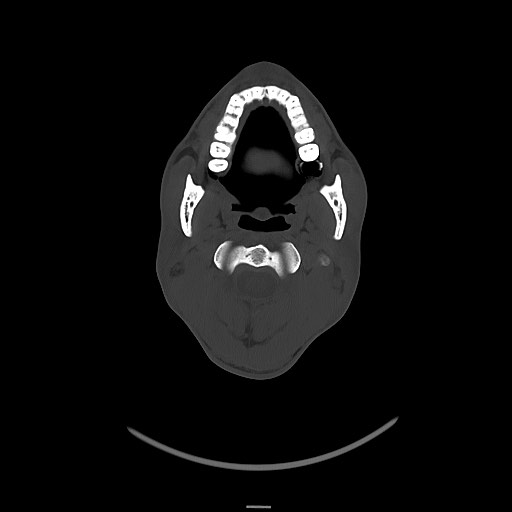 Arrow injury to the brain (Radiopaedia 72101-82607 Axial bone window 42).jpg