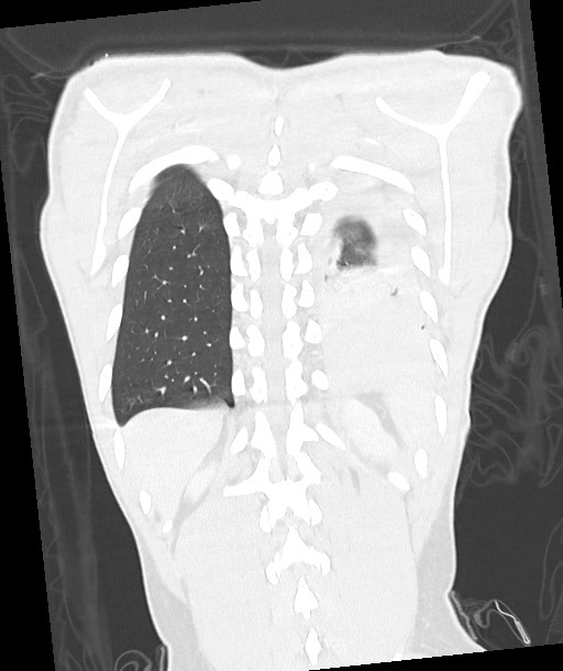 Arrow injury to the chest (Radiopaedia 85367-100975 Coronal lung window 107).jpg