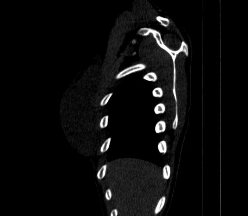 Arteria lusoria (Radiopaedia 88528-105192 C 18).jpg