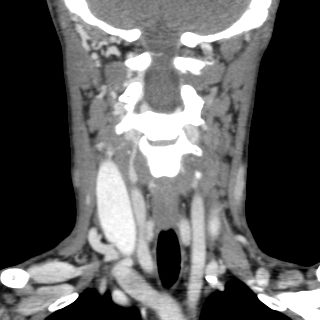 File:Arteriovenous malformation of the neck (Radiopaedia 53935-60062 D 4).jpg