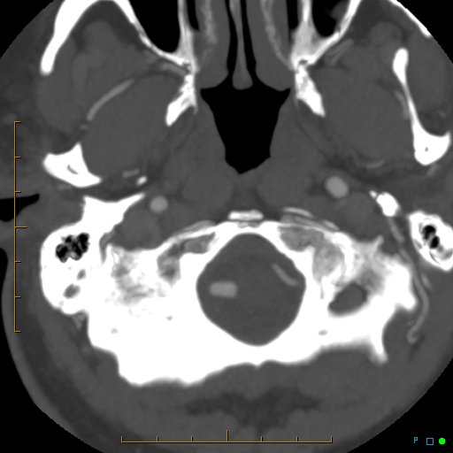 File:Artifactual basilar artery stenosis due to metallic stent (Radiopaedia 31206-31923 A 3).jpg