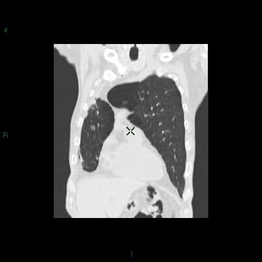 File:Aspergilloma (Radiopaedia 14842-14787 Coronal lung window 9).jpg