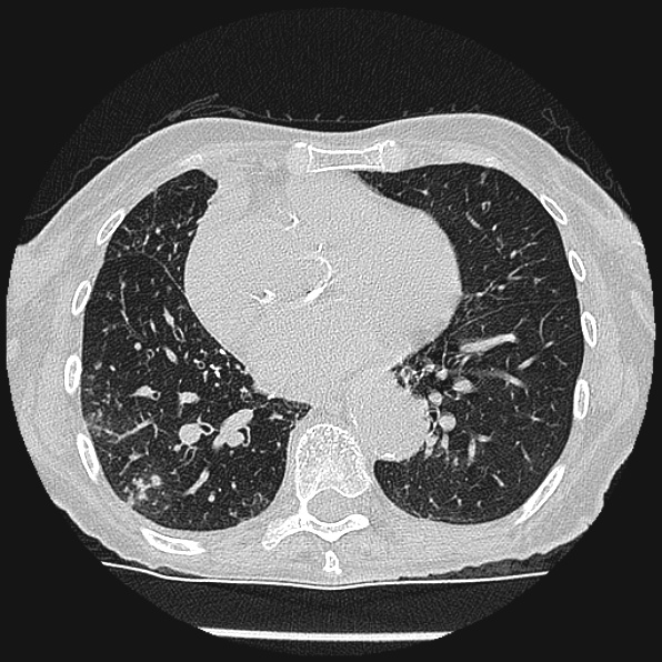 Aspergilloma (Radiopaedia 24458-24763 Axial lung window 43).jpg