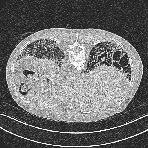 File:Aspergilloma on background pulmonary fibrosis (Radiopaedia 60942-68757 Axial lung window 27).jpg
