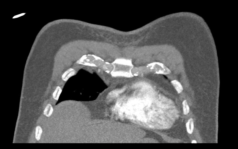 Aspirated tooth (Radiopaedia 28584-28844 Coronal C+ CTPA 13).jpg