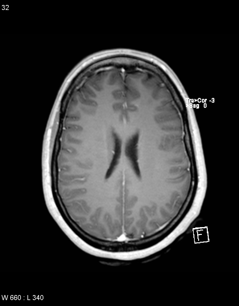 Astroblastoma (Radiopaedia 39792-42218 Axial T1 C+ 31).jpg