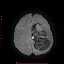 Astroblastoma (Radiopaedia 74287-85162 Axial DWI 80).jpg