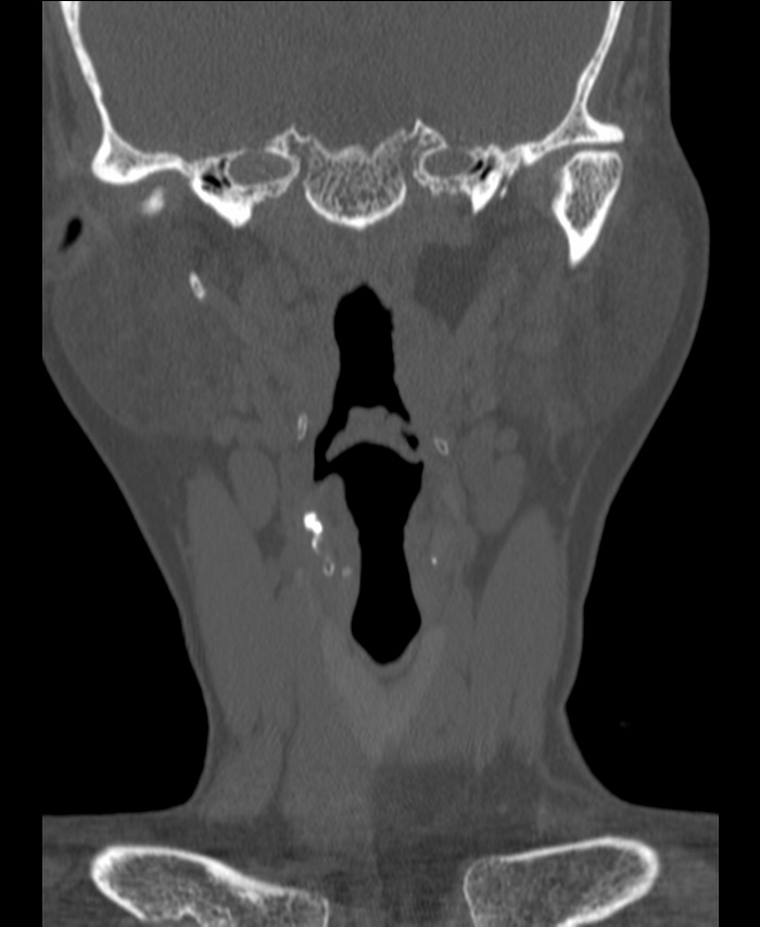 Atlanto-occipital assimilation with basilar invagination (Radiopaedia 70122-80188 Coronal bone window 16).jpg