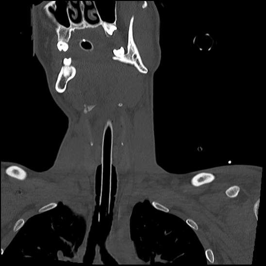 Atlanto-occipital dissociation (Traynelis type 1), C2 teardrop fracture, C6-7 facet joint dislocation (Radiopaedia 87655-104061 Coronal bone window 21).jpg