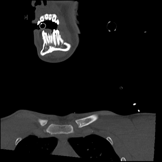 Atlanto-occipital dissociation (Traynelis type 1), C2 teardrop fracture, C6-7 facet joint dislocation (Radiopaedia 87655-104061 Coronal bone window 5).jpg