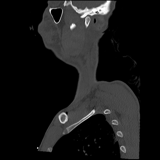 Atlanto-occipital dissociation (Traynelis type 1), C2 teardrop fracture, C6-7 facet joint dislocation (Radiopaedia 87655-104061 Sagittal bone window 5).jpg