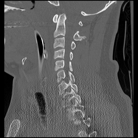 File:Atlanto-occipital dissociation injury (Radiopaedia 29274-29698 Sagittal bone window 26).png